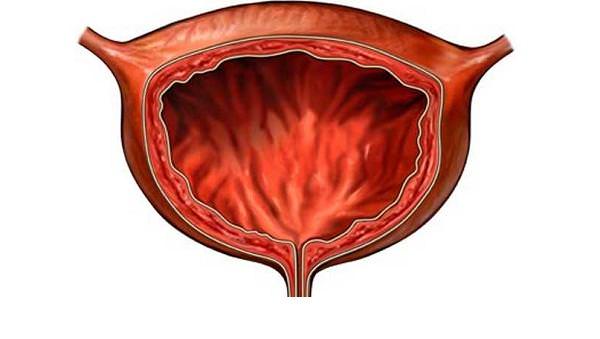 Интерстициальный цистит причины 