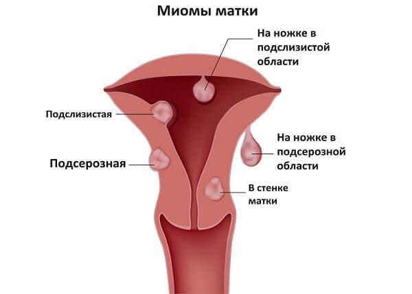 Как распознать миому матки 