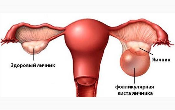 Киста на яичнике опасность заболевания