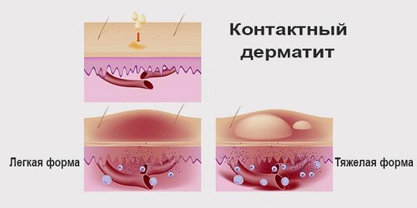 Контактный дерматит