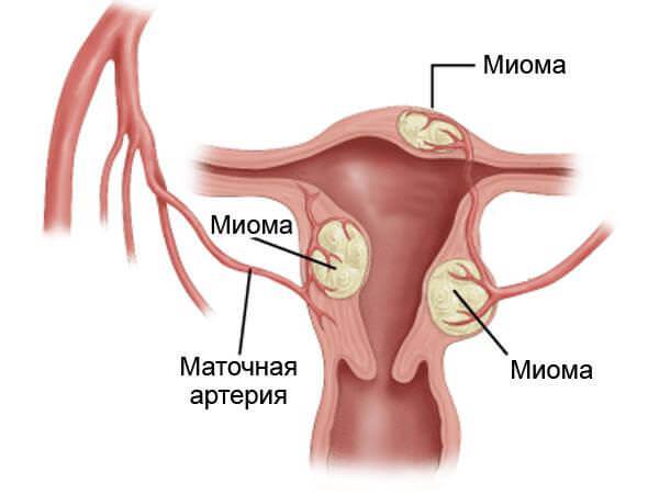 Миома матки что это