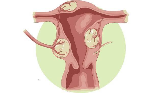 Миома матки