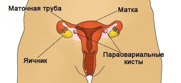 Параовариальная киста яичника что это