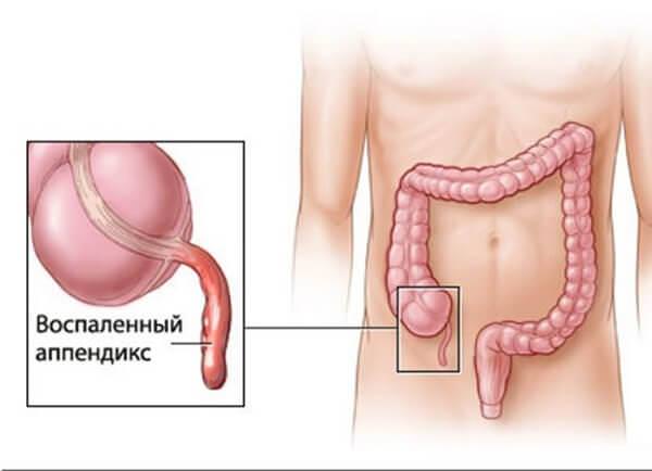 Флегмонозный аппендицит причины