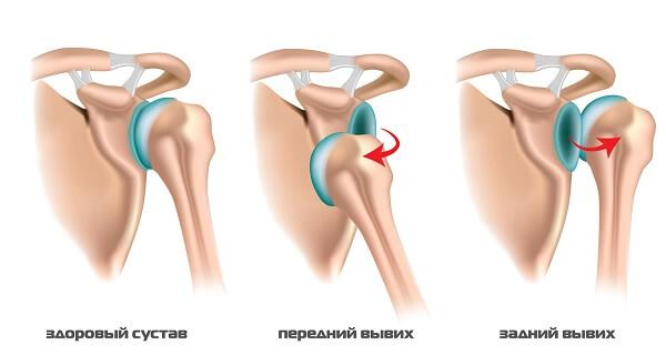 Вывих плечевого сустава какие бывают