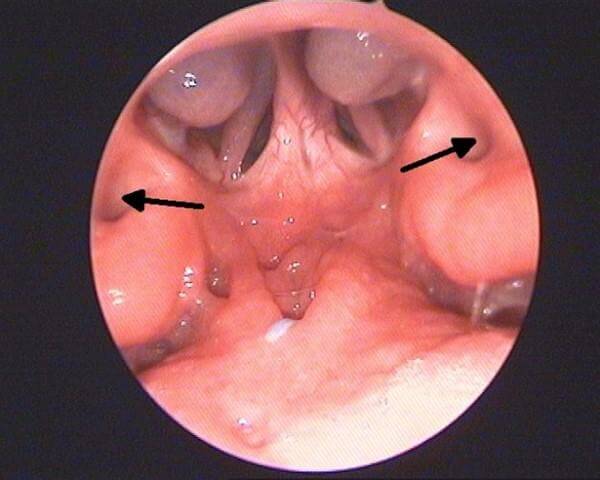 Стадии заболевания
