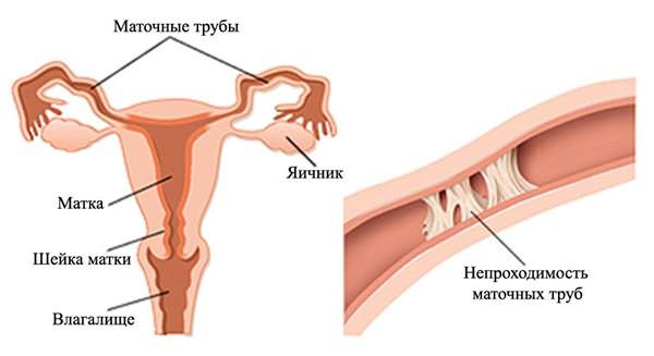 Хроническая ановуляция