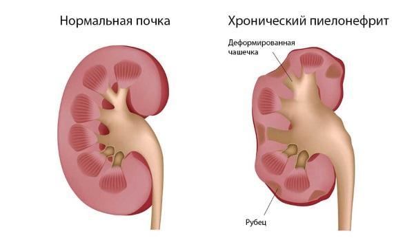 Виды пиелонефрита